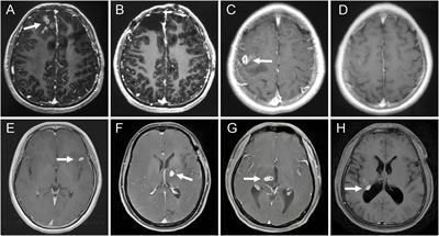 The serum IgG antibody level as a biomarker for clinical outcome in patients with cerebral sparganosis after treatment